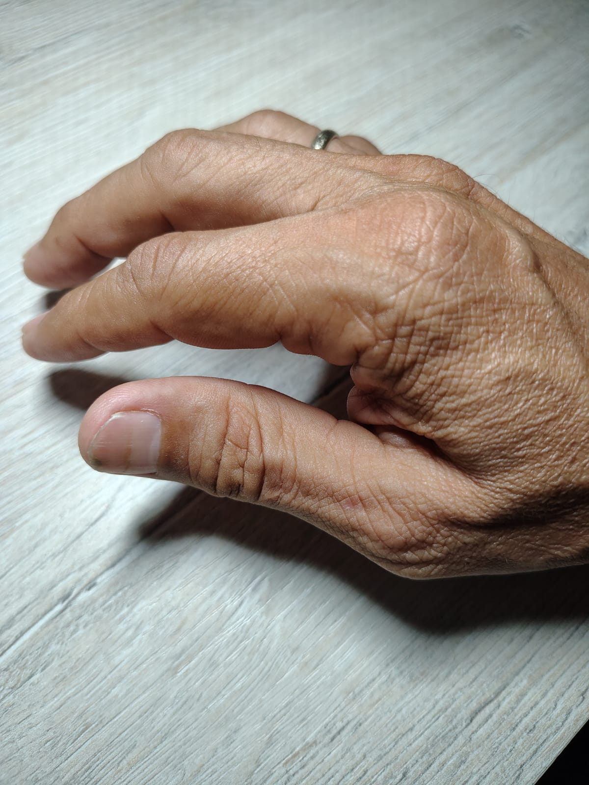 Ácido úrico, inflamación en nudillos y dolor lumbar: posibles vínculos y el papel del ayuno de 36 horas